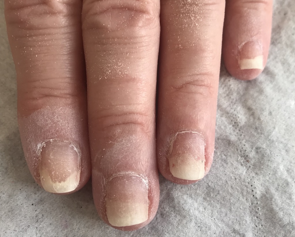 How to Tell If You're Allergic to Your Gel Manicure